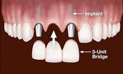 Bridge Dental Implant