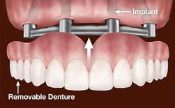 Removable Denture Implant